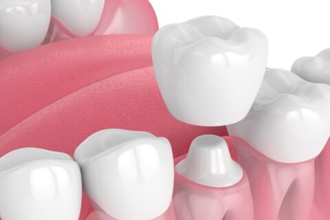 3D dental crown illustration showing tooth restoration in Grand Rapids, MI