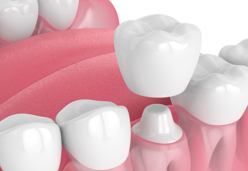 3D dental crown illustration showing tooth restoration in Grand Rapids, MI