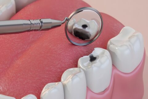Close-up of cavity formation and tooth decay highlighted with a dental mirror in Grand Rapids, MI